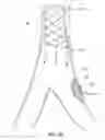 Fig. 08 - Method and apparatus for treating vulnerable plaque
