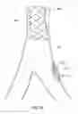 Fig. 09 - Method and apparatus for treating vulnerable plaque