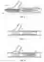 Fig. 03 - Methods and devices for protecting passageway in a body when advancing devices through the passageway