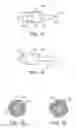 Fig. 08 - Methods and devices for protecting passageway in a body when advancing devices through the passageway