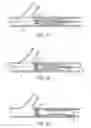 Fig. 10 - Methods and devices for protecting passageway in a body when advancing devices through the passageway