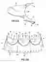 Fig. 04 - Heart valve prosthesis and methods of manufacture and use