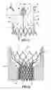 Fig. 06 - Heart valve prosthesis and methods of manufacture and use
