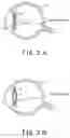 Fig. 03 - Intraocular lens