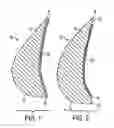 Fig. 02 - Breast prosthesis