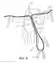 Fig. 04 - Apparatus and method for reconstructing a ligament