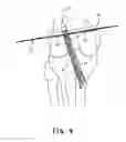 Fig. 05 - Apparatus and method for reconstructing a ligament