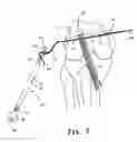 Fig. 06 - Apparatus and method for reconstructing a ligament