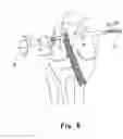 Fig. 07 - Apparatus and method for reconstructing a ligament