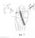 Fig. 08 - Apparatus and method for reconstructing a ligament