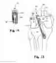 Fig. 13 - Apparatus and method for reconstructing a ligament