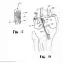 Fig. 15 - Apparatus and method for reconstructing a ligament