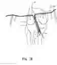 Fig. 16 - Apparatus and method for reconstructing a ligament