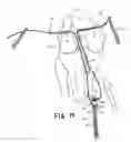 Fig. 17 - Apparatus and method for reconstructing a ligament