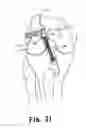 Fig. 19 - Apparatus and method for reconstructing a ligament