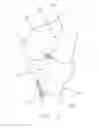 Fig. 07 - Apparatus and method for reconstructing a ligament