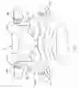 Fig. 03 - Multiple facet joint replacement
