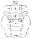 Fig. 03 - Intervertebral spacer device