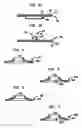 Fig. 04 - Intervertebral spacer device