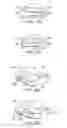 Fig. 07 - Posterior spinal arthroplasty-development of a new posteriorly inserted artificial disc, a new anteriorly inserted artifical disc and an artificial facet joint