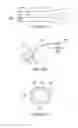 Fig. 16 - Posterior spinal arthroplasty-development of a new posteriorly inserted artificial disc, a new anteriorly inserted artifical disc and an artificial facet joint