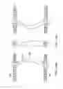 Fig. 19 - Posterior spinal arthroplasty-development of a new posteriorly inserted artificial disc, a new anteriorly inserted artifical disc and an artificial facet joint