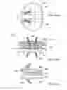 Fig. 29 - Posterior spinal arthroplasty-development of a new posteriorly inserted artificial disc, a new anteriorly inserted artifical disc and an artificial facet joint
