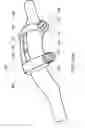 Fig. 45 - Posterior spinal arthroplasty-development of a new posteriorly inserted artificial disc, a new anteriorly inserted artifical disc and an artificial facet joint