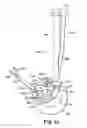 Fig. 14 - Catheter holder for spinal implant