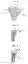 Fig. 04 - Modular keel tibial component