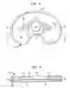 Fig. 05 - Modular keel tibial component