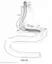 Fig. 37 - Intestinal sleeve