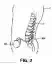 Fig. 04 - Therapy management techniques for an implantable medical device