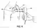 Fig. 06 - Therapy management techniques for an implantable medical device