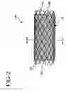 Fig. 03 - Stent-graft with bioabsorbable structural support