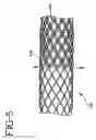 Fig. 08 - Stent-graft with bioabsorbable structural support