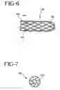 Fig. 09 - Stent-graft with bioabsorbable structural support