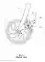 Fig. 10 - Integral combination of front fork and disk brake assembly