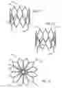 Fig. 06 - Nitinol frame heating and setting mandrel