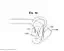 Fig. 12 - Multi-coil coupling system for hearing aid applications