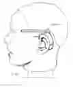 Fig. 31 - Multi-coil coupling system for hearing aid applications
