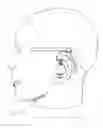 Fig. 32 - Multi-coil coupling system for hearing aid applications