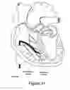Fig. 12 - Cardioscopy
