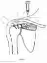 Fig. 03 - Method of repairing tendons by surgery