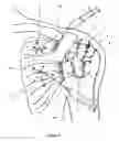 Fig. 04 - Method of repairing tendons by surgery
