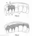Fig. 03 - Methods and systems for enabling and stabilizing tooth movement