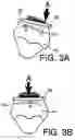 Fig. 04 - ORTHODONTIC BRACKET