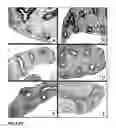 Fig. 16 - Inhibition of stem cell differentiation, enhancement of proliferation and selective induction of apoptosis by WNT factors