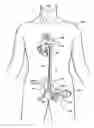 Fig. 01 - Multilumen catheter for minimizing limb ischemia