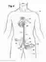 Fig. 04 - Multilumen catheter for minimizing limb ischemia